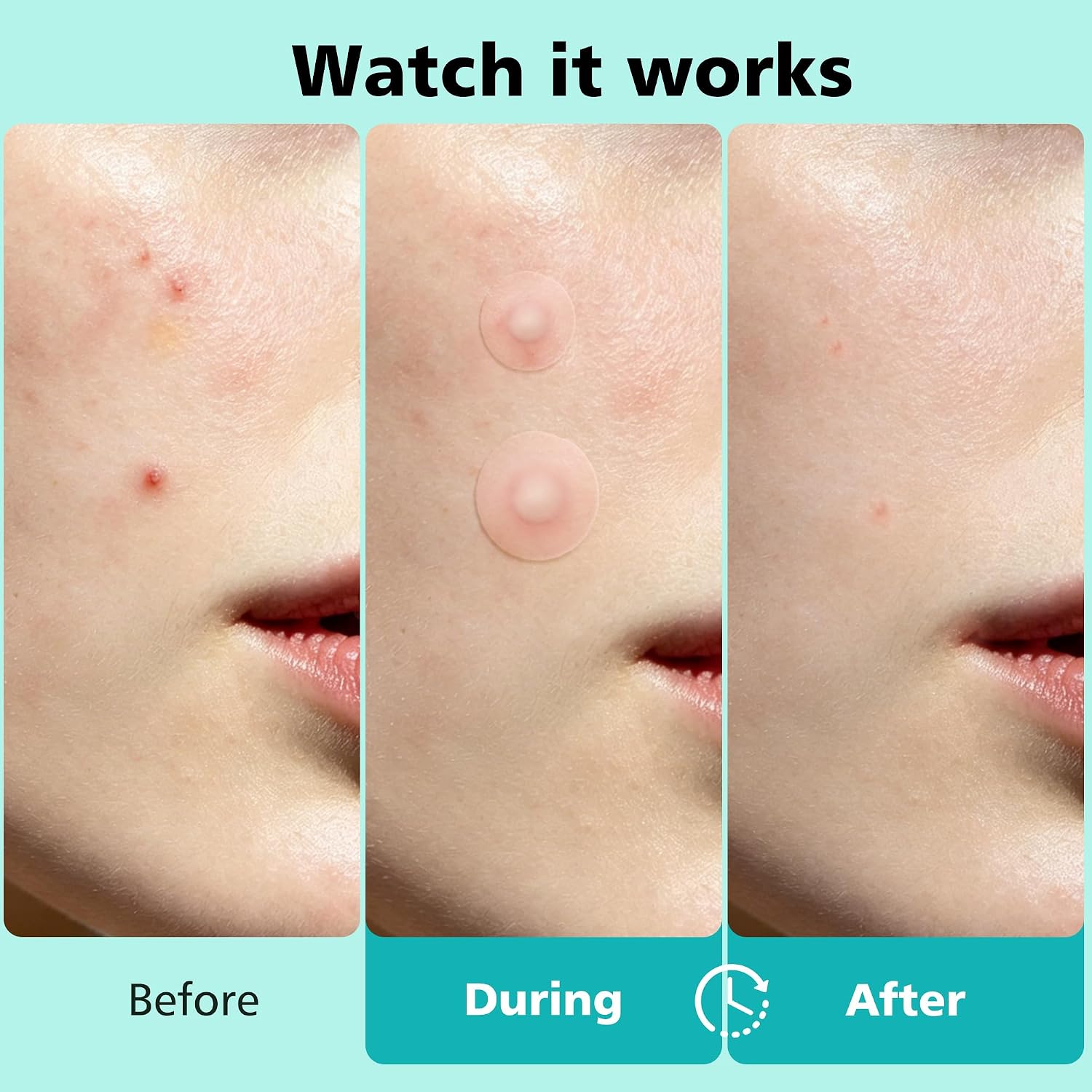 563 Count Pimple Patches - Hydrocolloid Acne Patches for Face & Body, Invisible Thin, Large & Small Sizes for Whiteheads, Zits & Breakouts (Dots, Strip, Contoured 6 Sizes)